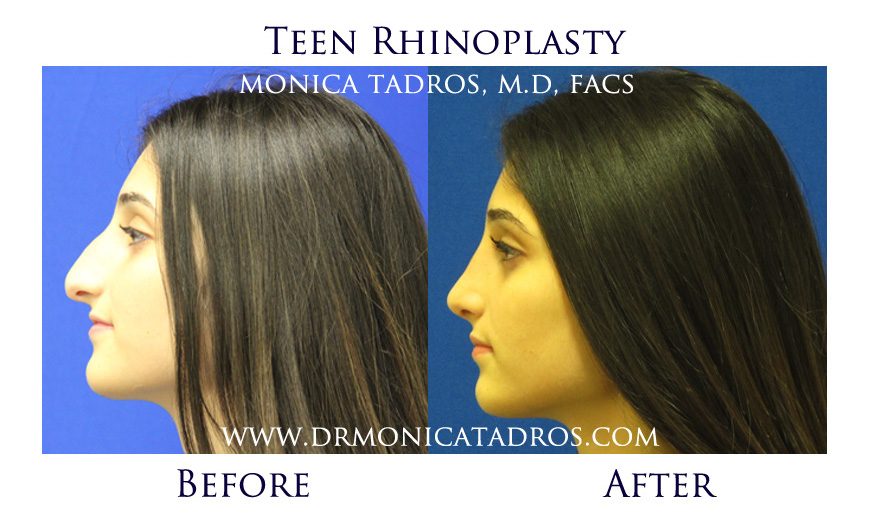 NJ Teen Rhinoplasty Before and After