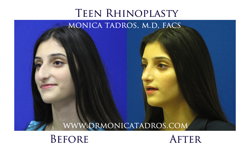 Before and After Teen Nose Reconstruction Procedure