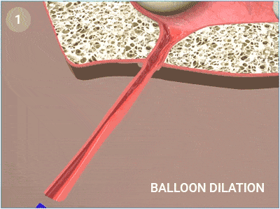 Steps of Balloon Sinuplasty (Balloon Sinus Dilation)
