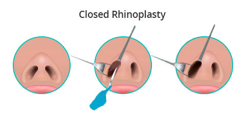 Closed Rhinoplasty in NYC & NJ