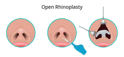 Open Rhinoplasty in NYC & NJ
