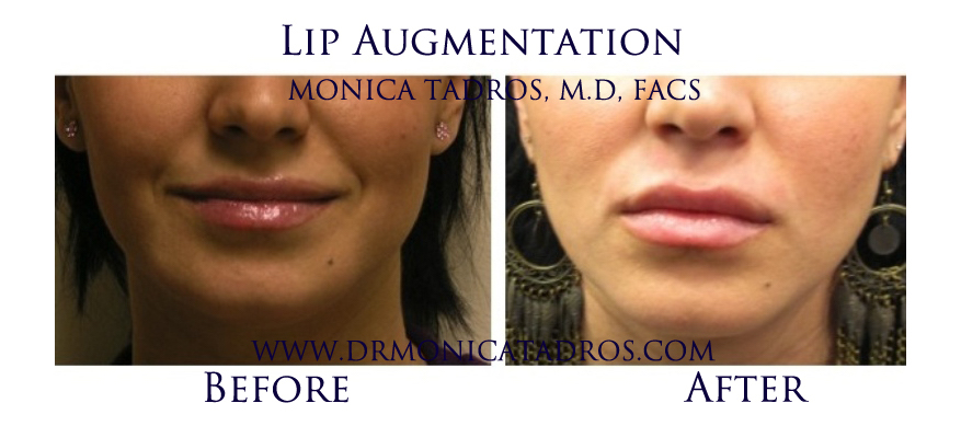 The Truth About Lip Augmentation 
