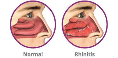 Getting Nasal Relief Without Surgery 