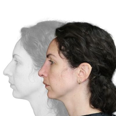2024-10-30_Dr Monica Tadros_B and A Rhinoplasty_8_CC